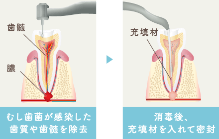 むし歯菌が感染した歯質や歯髄を除去 消毒後、充填材を入れて密封